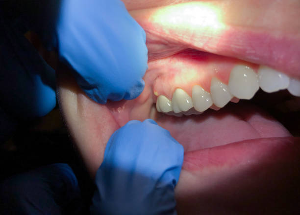 Best Emergency Dentist for Knocked-Out Tooth in Hartwell, GA